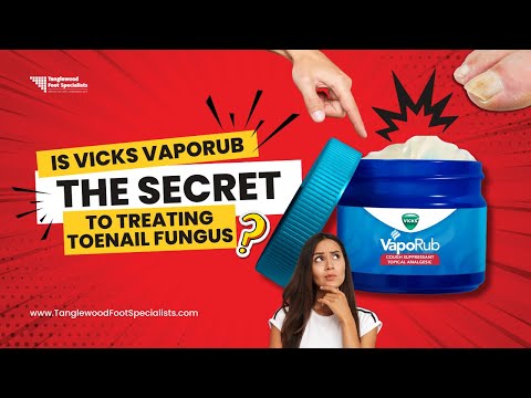 Видео: Является ли мазь Vicks VapoRub секретом лечения грибка ногтей на ногах?