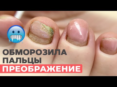 Видео: Обмороженные пальцы | Проблемные ногти | Исправляем