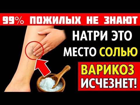 Видео: Соль и варикоз: простой секрет для лёгких ног после 60. Три шага к здоровью и радости жизни