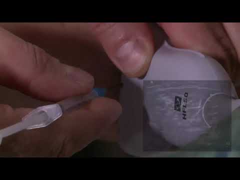 Видео: Мастер - класс: ведение ботулинотоксина. Лечение болевой спастичности в руке.