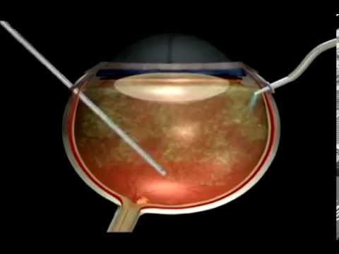 Видео: Макулярный разрыв сетчатки глаза - причины и лечение