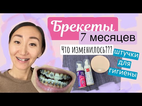Видео: БРЕКЕТЫ😬//7 МЕСЯЦЕВ🌛//ЧТО ИЗМЕНИЛОСЬ🧐???