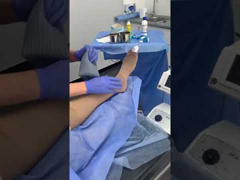 Видео: Самый новый метод как надеть компрессионный чулок. Батлер от SIGVARIS