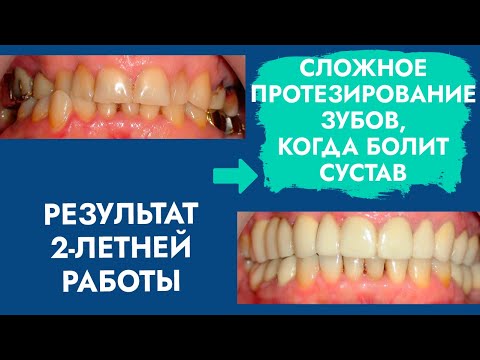 Видео: Сложное протезирование зубов. Болит сустав. Результат 2-летней работы.