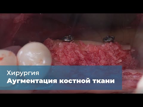 Видео: Аугментация костной ткани