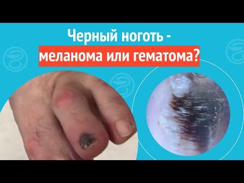 Видео: 💅 Черный ноготь - меланома или гематома?
