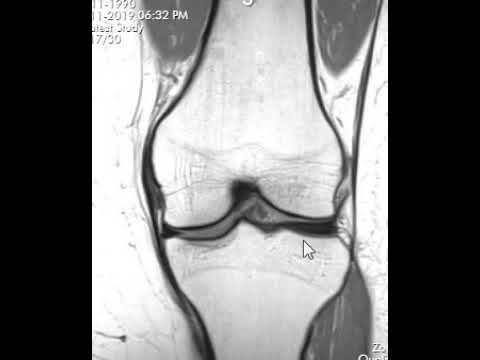 Видео: Как расшифровать МРТ колена | Первый взгляд на МРТ