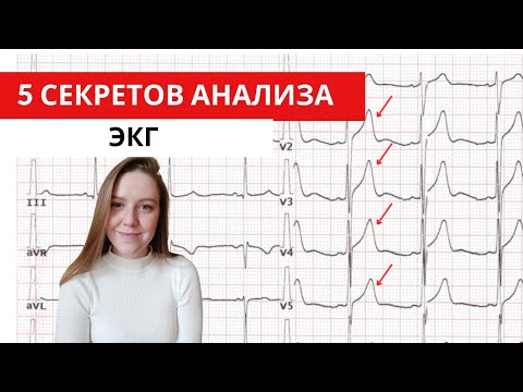 Видео: 5 секретов анализа ЭКГ