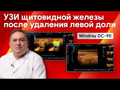 Видео: Мастер-класс на Mindray DC-90: УЗИ щитовидной железы с удаленной левой долей
