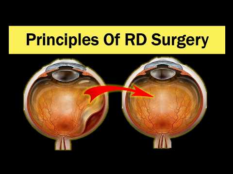 Видео: Как лечить отслойку сетчатки?