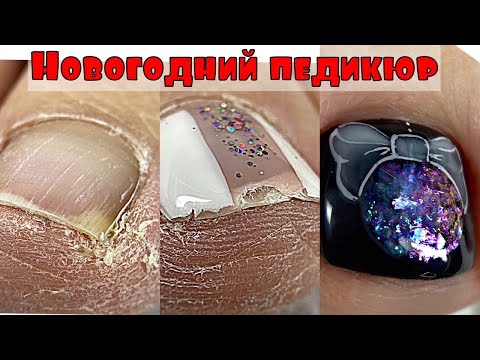 Видео: Педикюр на сухих ногах💅 Как вычистить подногтевую мозоль💅 Новогодний дизайн ногтей на ногах