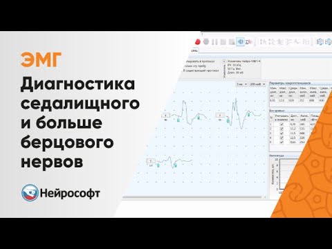 Видео: ЭМГ: Диагностика Повреждений Седалищного и Большеберцового Нервов