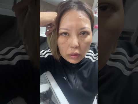 Видео: Парез лицевого нерва с 2018года