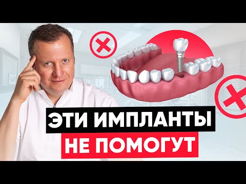 Видео: ЛУЧШИЕ импланты для идеальной улыбки: скуловые и длинные | Когда обычные импланты не помогут? 