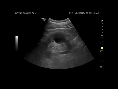 Видео: Ультразвуковая диагностика (УЗИ). Доктор Иогансен. Видеопримеры. Выпуск 29. Кисты почек (2).