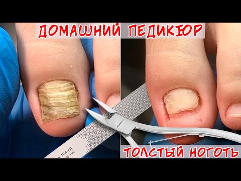 Видео: Как подстричь толстые ногти на ногах? / Толстый ноготь на ноге, что делать?