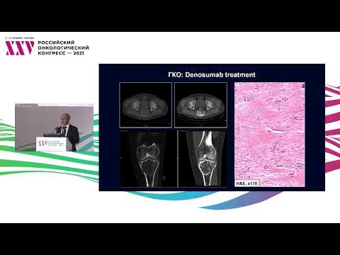 Видео: Дифференциальная диагностика гигантоклеточной опухоли