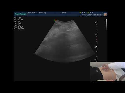 Видео: Практическая демонстрация к лекции "Оценка нижней полой вены при абдоминальном УЗИ" 10.03.20