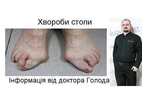 Видео: 24. Хвороби стоп