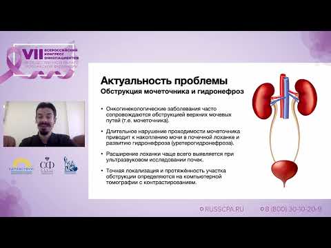Видео: Шатылко Т.В. | Дренирование верхних мочевых путей при опухолях женских половых органов