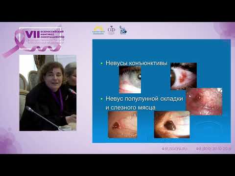 Видео: Иванова О.А. | Меланоцитарные опухоли у детей
