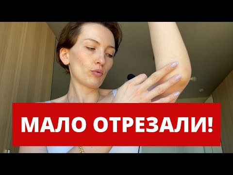 Видео: ВСЕ ПЛОХО | 3 МЕСЯЦА | ПОДТЯЖКА ЖИВОТА И РУК | ДО И ПОСЛЕ | БЕЗ ПЛАСТЫРЕЙ | АБДОМИНОПЛАСТИКА