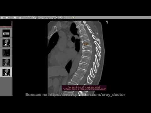 Видео: Разбор КТ позвоночник + xray калькуляторы