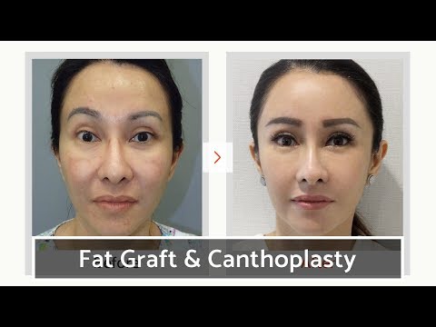 Видео: Липофилинг и латеральная кантопластика | Клиника VIP в Южной Корее