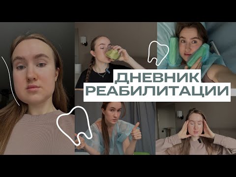 Видео: Удалила все зубы мудрости за один раз | удаление под седацией | подготовка к члх