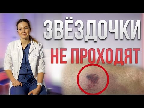 Видео: Почему звёздочки не проходят после склеротерапии