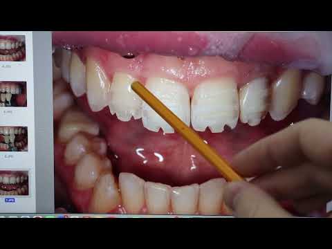 Видео: Стомбудни#11 ЗАЛЕПИЛ ДЫРКУ?