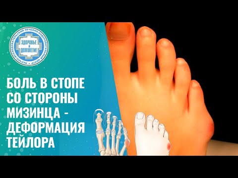 Видео: 🦶 🤦 Шишка-деформация стопы со стороны мизинца или «болезнь портного»
