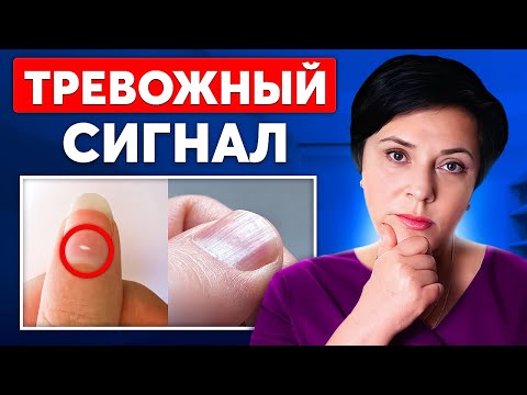 Видео: Как по ногтям определить проблемы со здоровьем? 10 ОПАСНЫХ ПРИЗНАКОВ