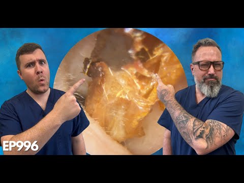Видео: УДАЛЕНИЕ СУХОЙ КОЖИ ИЗ УШНОГО ПРОХОДА - EP996