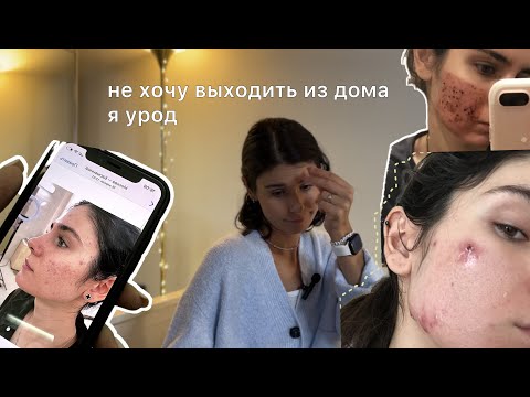 Видео: Жизнь с акне | комплексы, депрессия. как полюбить себя с прыщами и другими "недостатками"