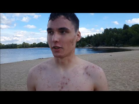 Видео: Шестой месяц лечения акнекутаном