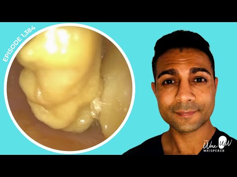 Видео: 1384 — Извлечен большой кусок омертвевшей кожи и остатков пищи после инфекции наружного уха