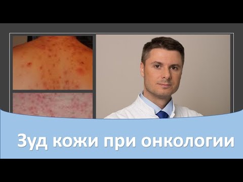 Видео: Зуд кожи при онкологии.