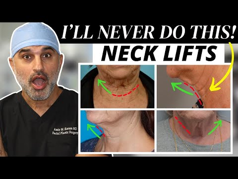 Видео: Стоит ли делать подтяжку шеи БЕЗ подтяжки лица?