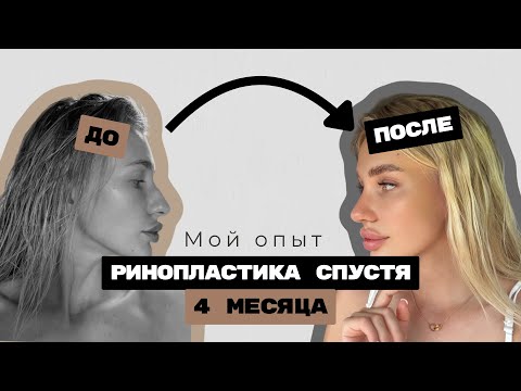 Видео: РИНОПЛАСТИКА спустя 4 месяца | Мой опыт, ощущения, нюансы, о которых молчат