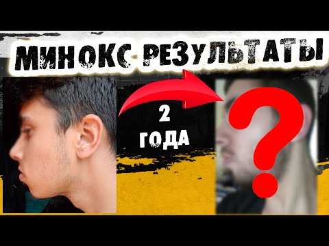 Видео: 2 года на курсе Минокса / как запустить рост бороды? / Выпуск 34 / Андрей борода