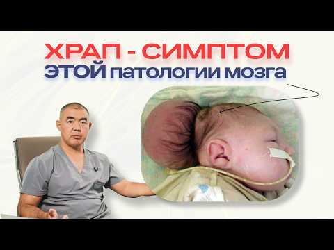 Видео: Аномалия Киари (мальформация Арнольда–Киари) — симптомы, диагностика и лечение | мнение нейрохирурга