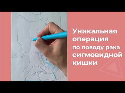 Видео: Как сохранить кишечник при раке сигмовидной кишки