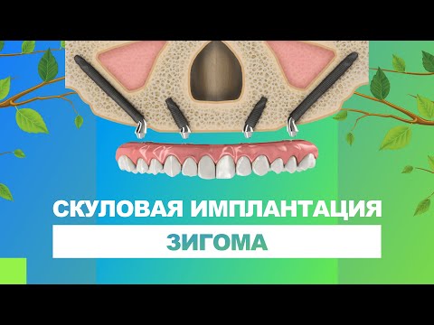 Видео: 🦷 Скуловая имплантация Зигома / Zygoma