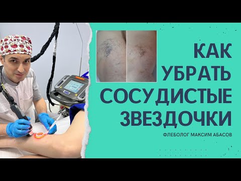 Видео: Как избавиться от сосудистых звездочек? Флеболог Москва.