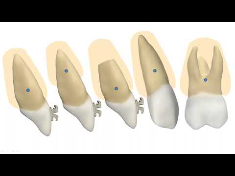 Видео: Центр сопротивления зуба