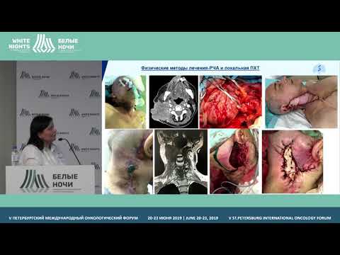 Видео: Комбинированное лечение рецидивного рака головы и шеи (Сукорцева Н.С)