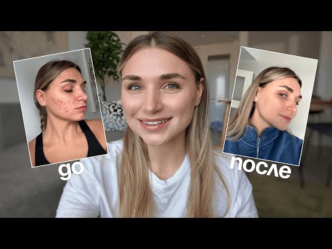 Видео: Как я вылечила акне: 7 месяцев на системных ретиноидах | До и После, побочки, уход, цена