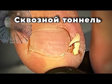 Видео: Ноготь прорубил тоннель в боковой пазухе. Не захотел оплатить сразу за два ногтя, пришёл через месяц