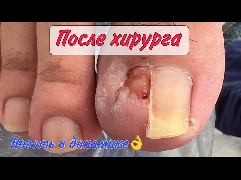 Видео: Ноготь после хирурга / вросший ноготь / подолог в москве
